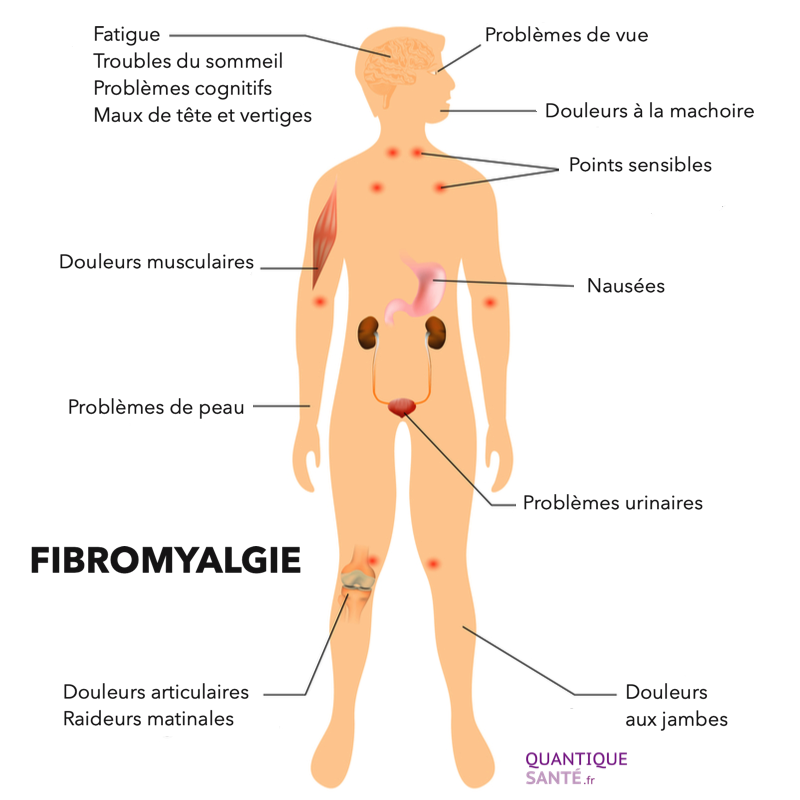 Schéma douleurs fibromyalgie